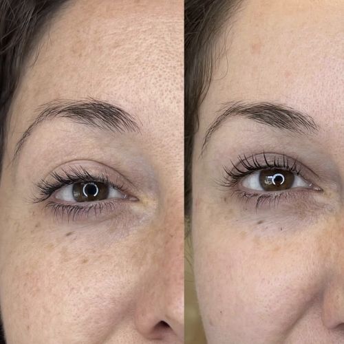 halo laser treatments in winchester va before and after bbl images