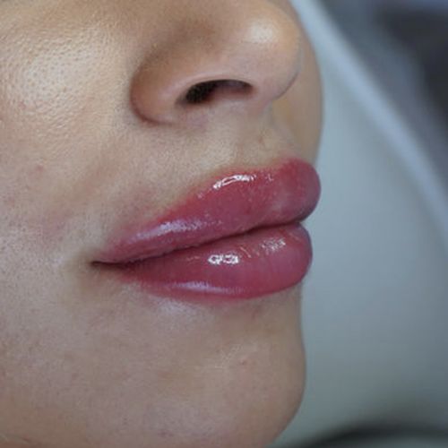 plump lips after treatment lip fillers in winchester va