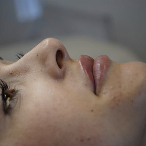 bbl photofacial treatments in winchester va facial closeup image