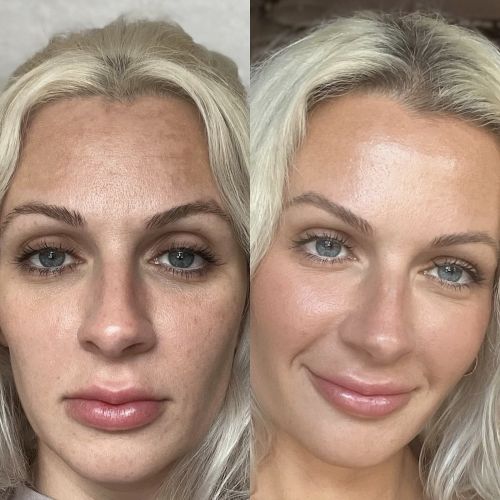 before and after halo laser treatments in winchester va