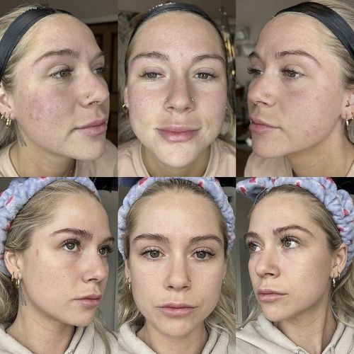 laser skin resurfacing in winchester va before and after photos