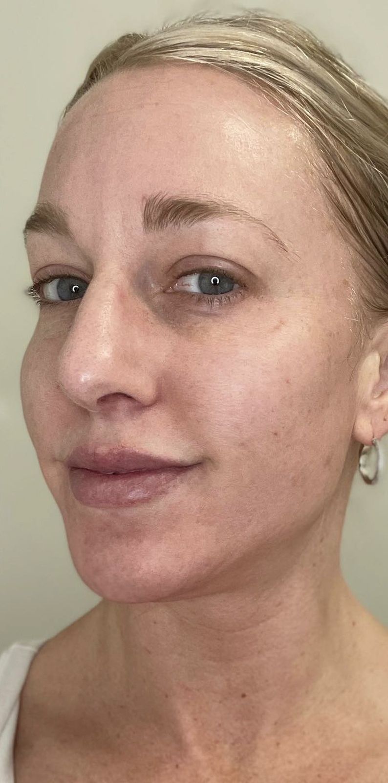 facial treatment after results med spa Winchester VA