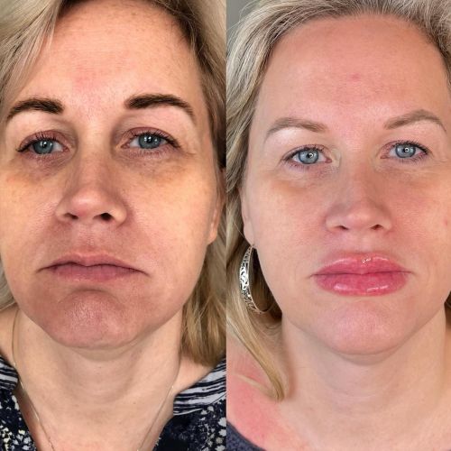 botox injections in winchester va facial treatment session