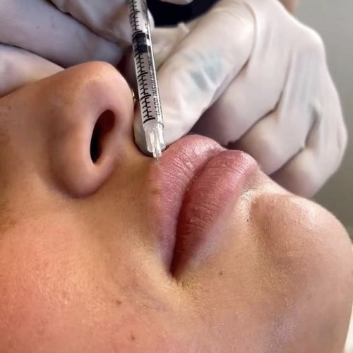 lip fillers in winchester va injection process close up