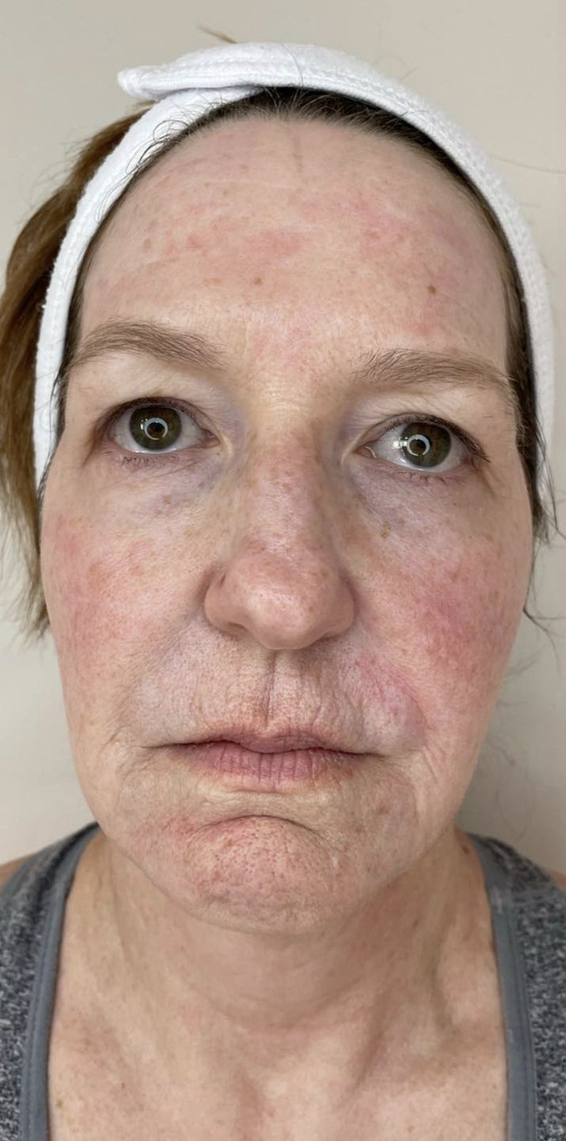 vas premier medical spa before and after skin treatment results