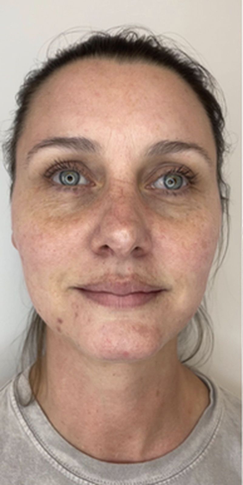 laser treatment before photo Beauty Lab Winchester VA