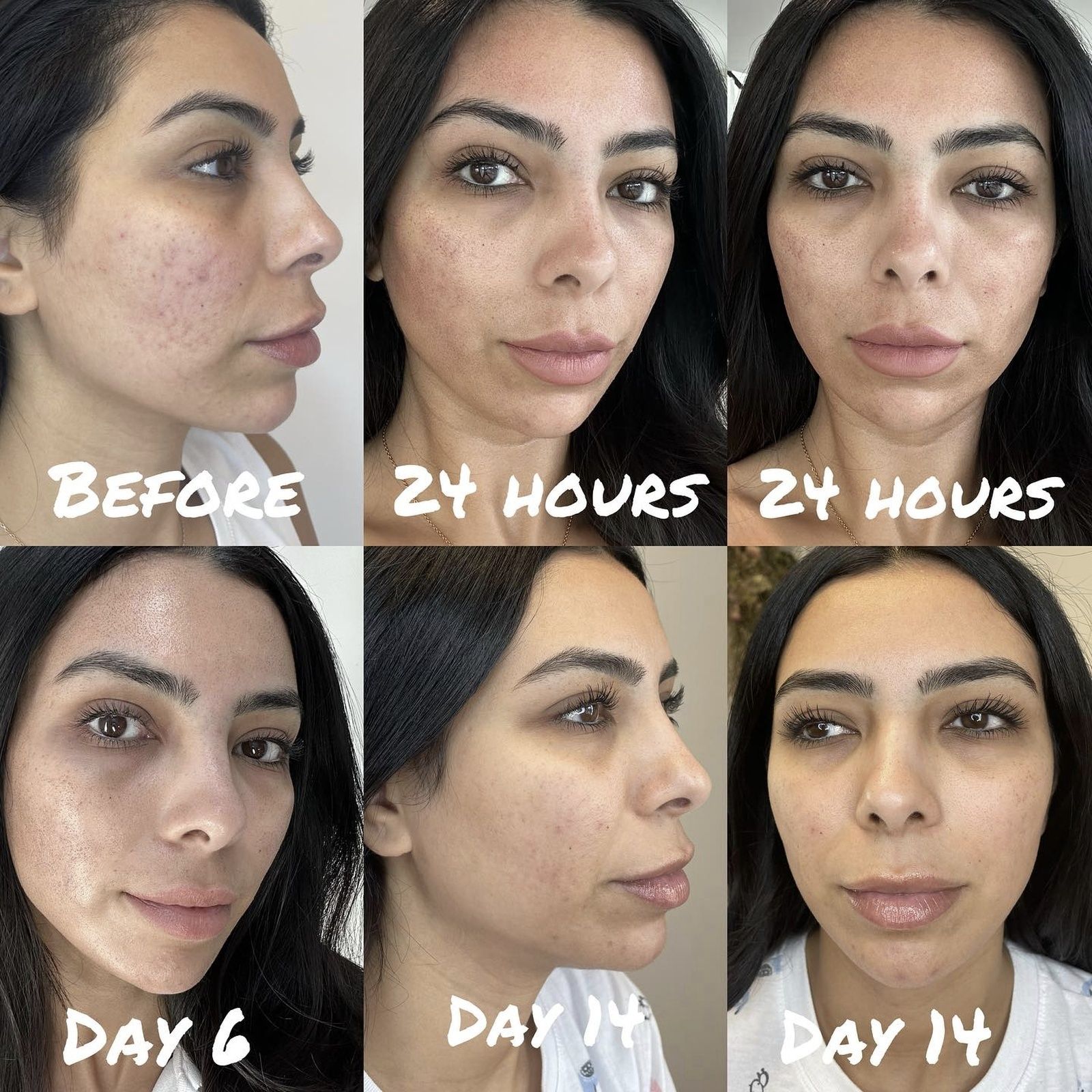 before and after skin treatment Beauty Lab & Laser Center Winchester VA