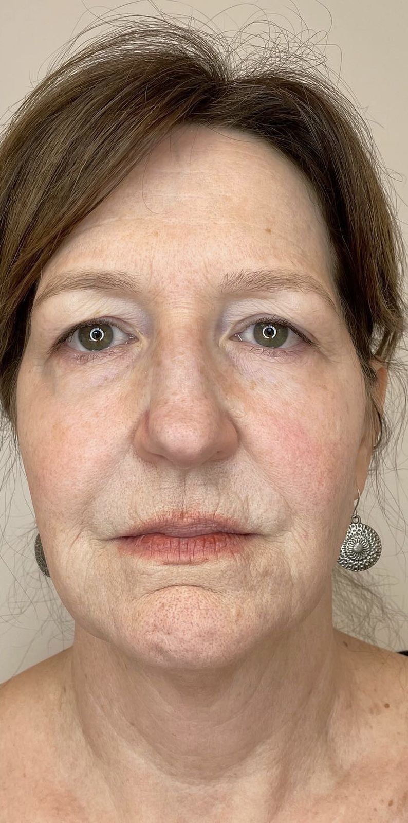 skin treatment after results Beauty Lab Winchester VA