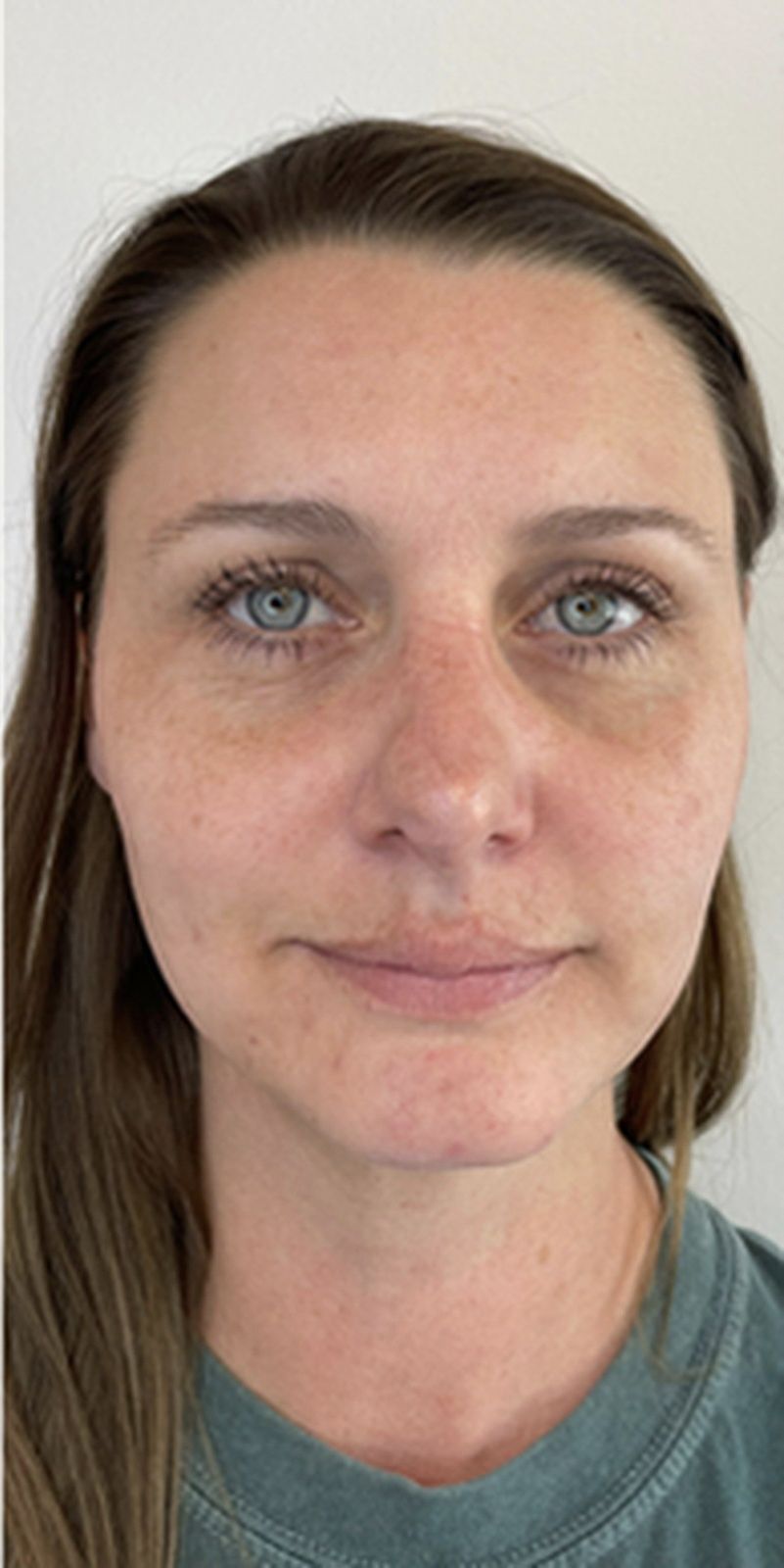 laser treatment after results Beauty Lab Winchester VA