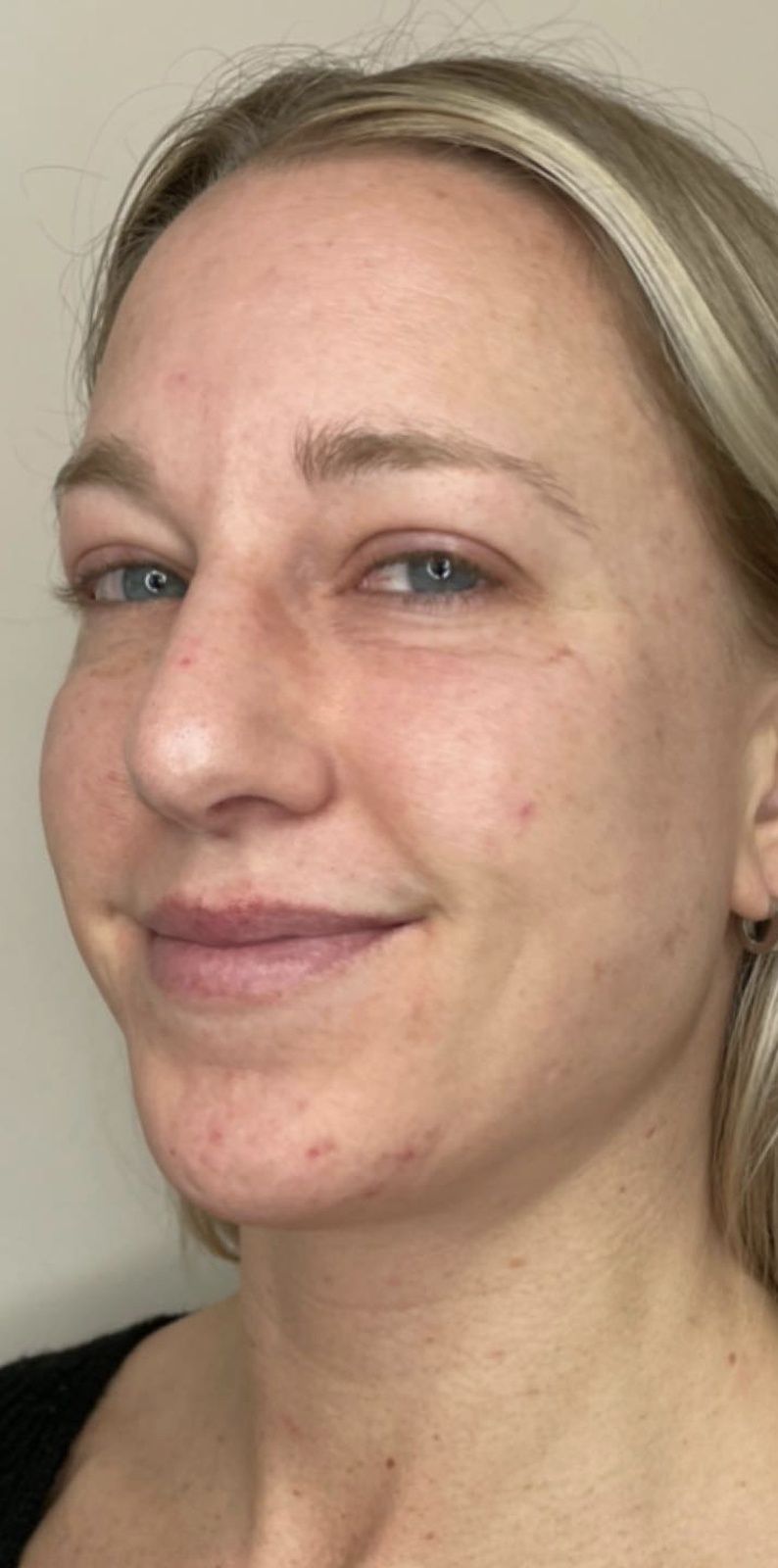 facial treatment before photo Beauty Lab Winchester VA