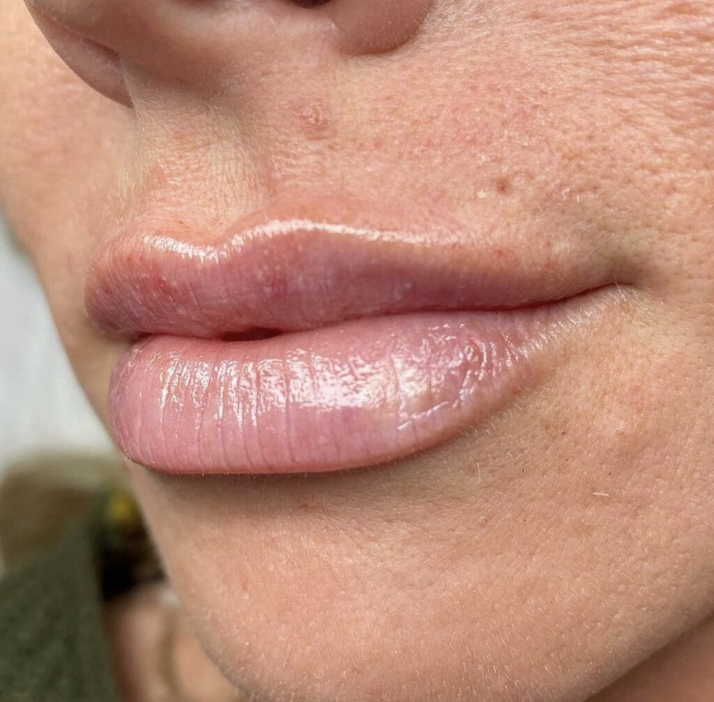 One to two months out: injectable timing, Beauty Lab and Laser Center