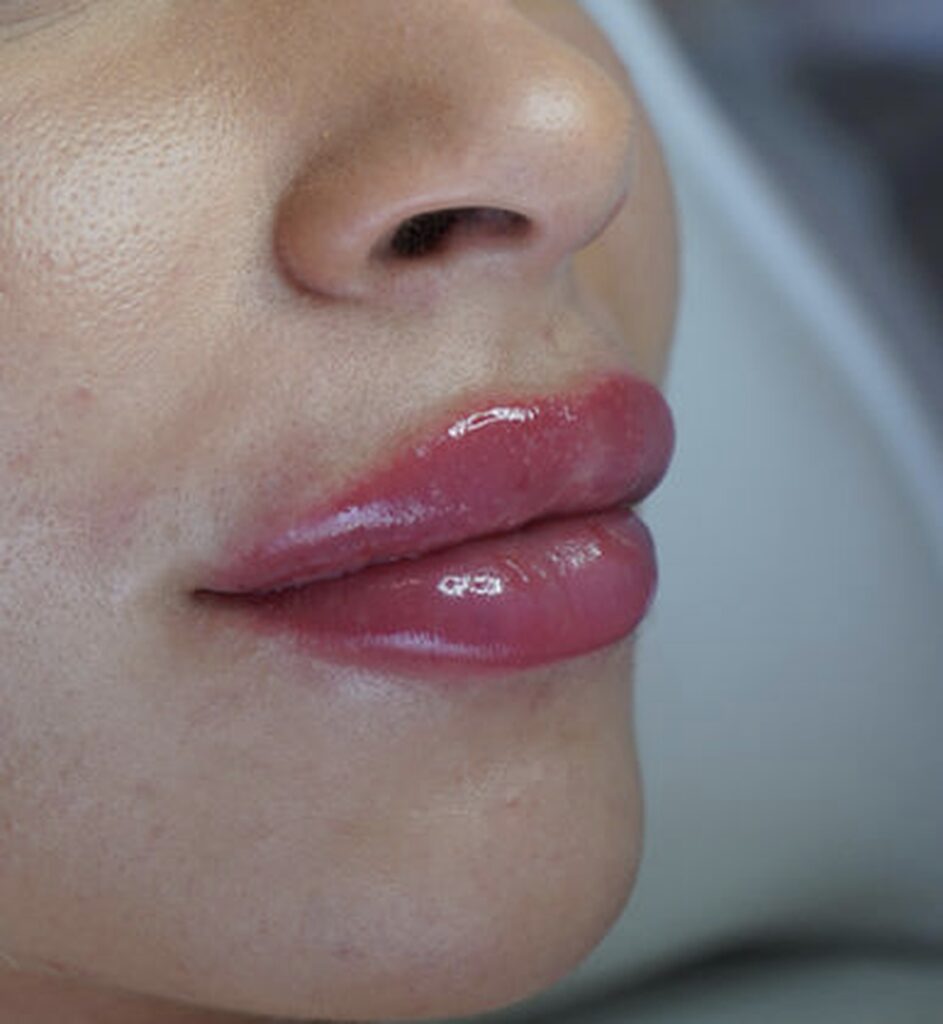 How can you make Botox and fillers last longer?, Beauty Lab and Laser Center