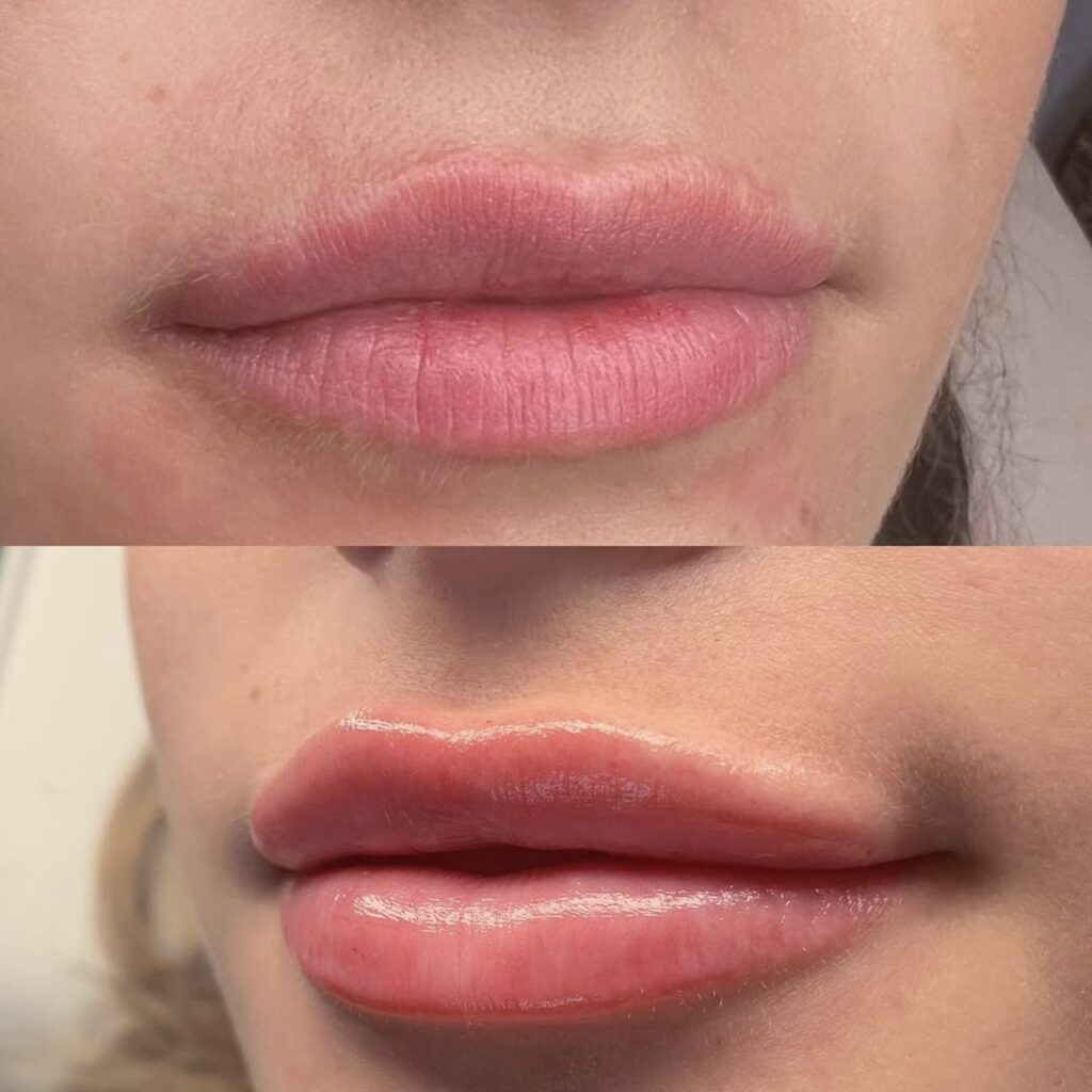 Does Botox freeze your face?, Beauty Lab and Laser Center